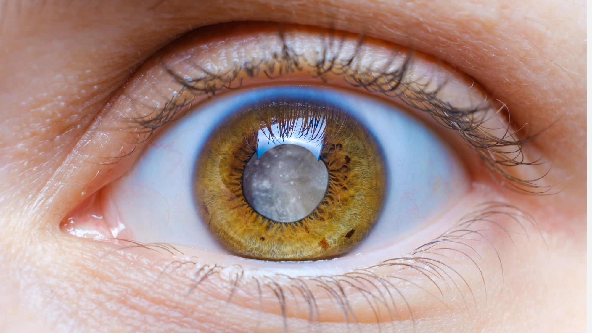 cataract surgery