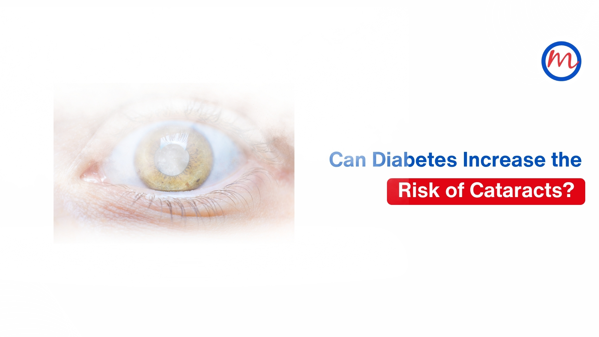 Cataracts