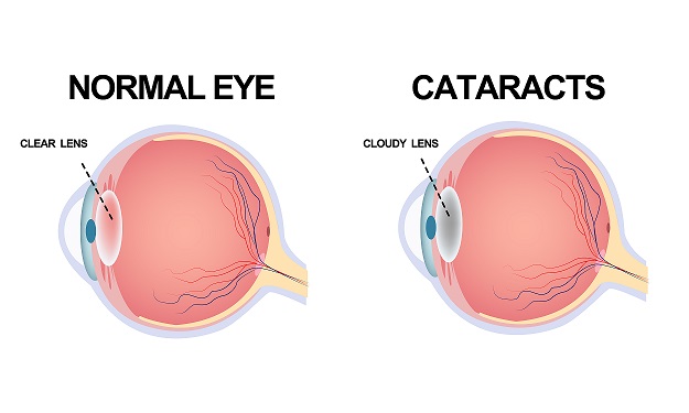 Diabetes and Cataract